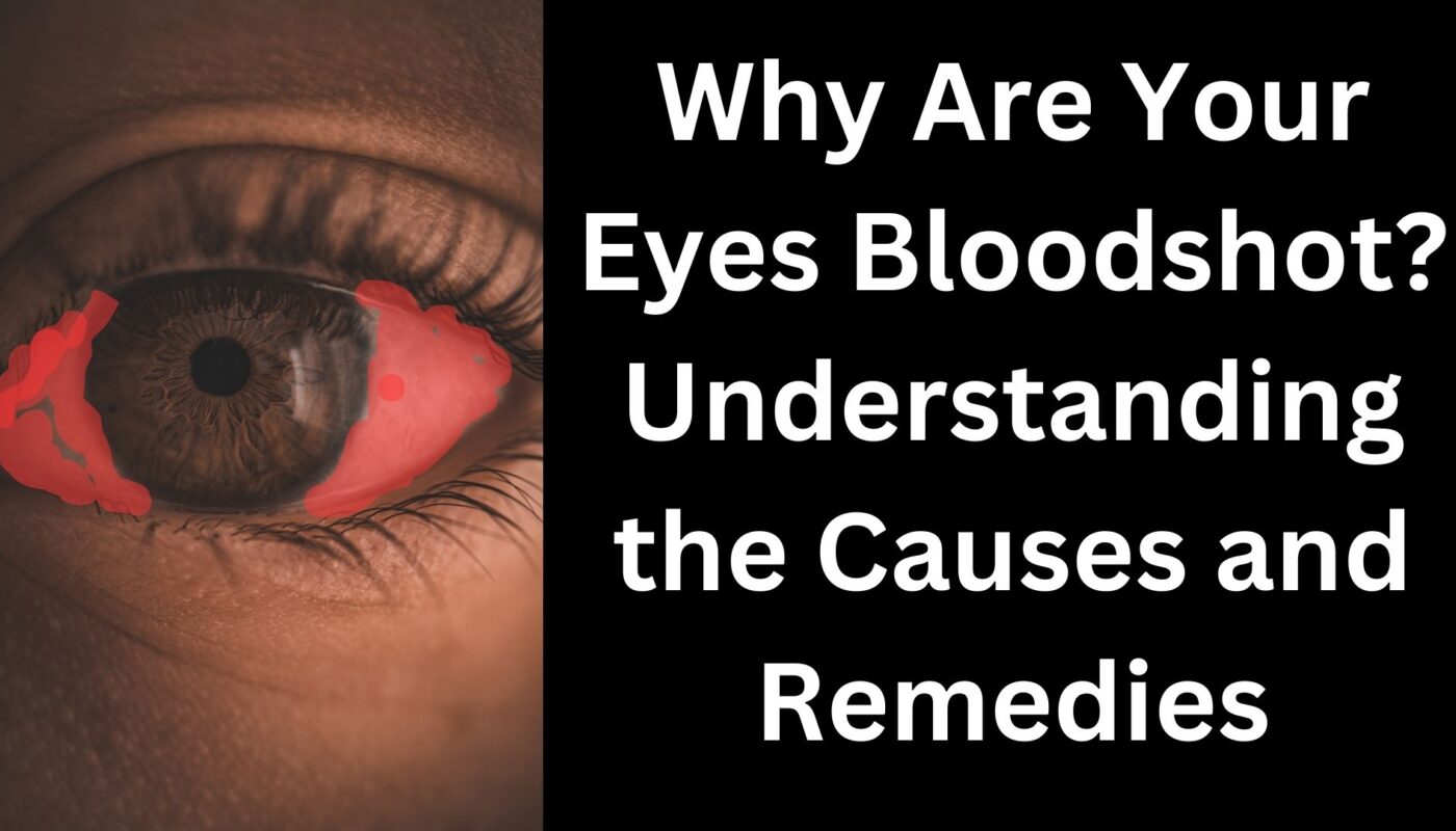 why are your eyes bloodshot?